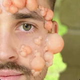 Large Infected Boils Prosthetic