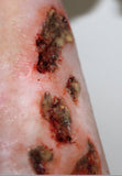 Infected Wound / Burn Prosthetic
