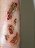 Infected Wound / Burn Prosthetic