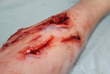 Deep Leg Lacerations Prosthetic