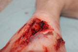 Deep Leg Lacerations Prosthetic