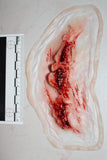 Deep Neck Wound Prosthetic