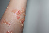 Infected/Burn Wound Prosthetics Bundle