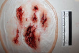 Deep Leg Lacerations Prosthetic
