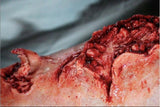Dog Bite Wound Prosthetic