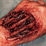 Exposed Ligaments Prosthetic Bundle