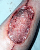 Infected Medical Skin Graft Prosthetic