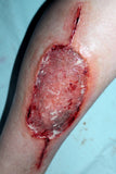 Infected Medical Skin Graft Prosthetic