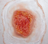 Deep Fatty Tissue Wound Prosthetic