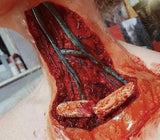 Open Collarbone Prosthetic