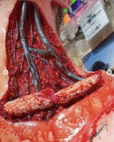 Open Collarbone Prosthetic