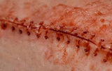 Opened Stitches Prosthetic