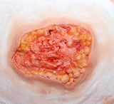 Deep Fatty Tissue Wound Prosthetic