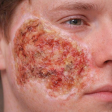 Zombie Face Burn Prosthetic