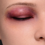 Swollen Upper Eyelid Prostheitc