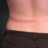 Healed Keloid Scar Prosthetic