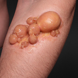 Infected Boils Prosthetic