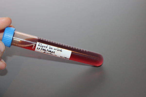 Simulated Blood in Urine Medical Specimen Tube