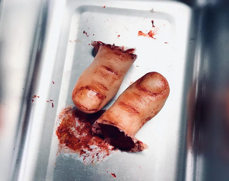 Severed Toe Prop
