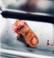 Severed Toe Prop