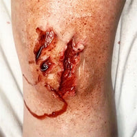 Outdoor Injuries Prosthetic Bundle