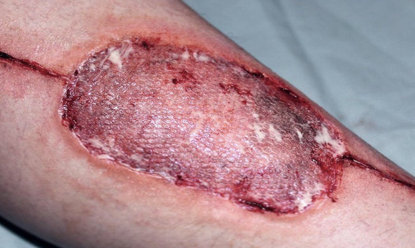 Infected Medical Skin Graft Prosthetic