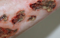 Infected Wound / Burn Prosthetic