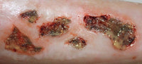 Infected Wound / Burn Prosthetic