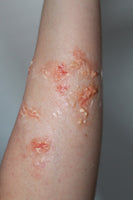 Infected Blisters / Boils Prosthetic