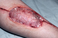 Infected Medical Skin Graft Prosthetic