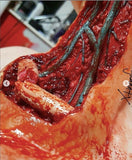 Open Collarbone Wound Prosthetic