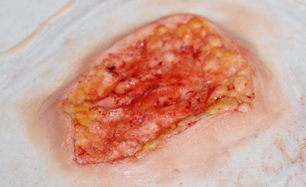 Deep Fatty Tissue Wound Prosthetic