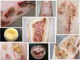 Infected/Burn Wound Prosthetics Bundle