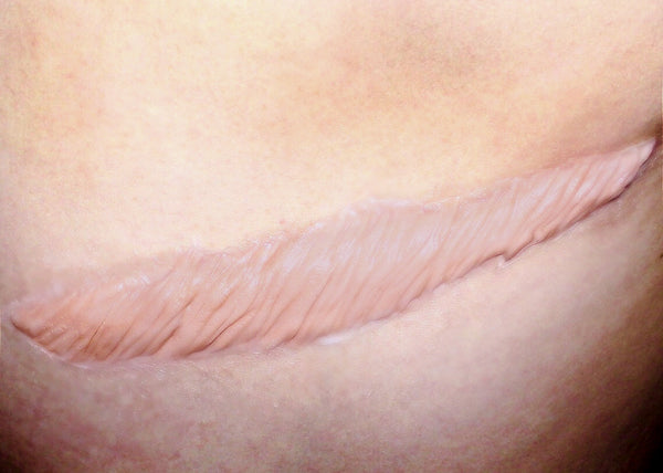 Large Healed Keloid Scar